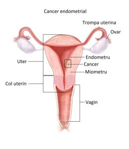 Cancerul de endometru | Spitalul Monza